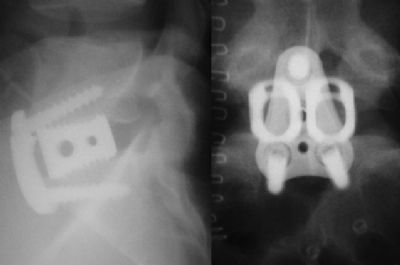 Medtronic LT Cages (Implant 199)