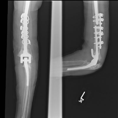 Synthes DCP Plate (Implant 69)