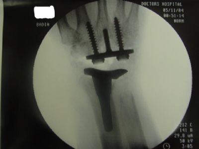 Wrist Prostheses:  KMI (Implant 195)