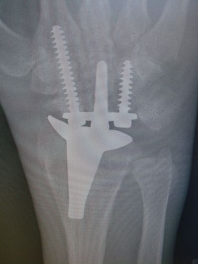 Wrist Prostheses:  SBI (Implant 614)