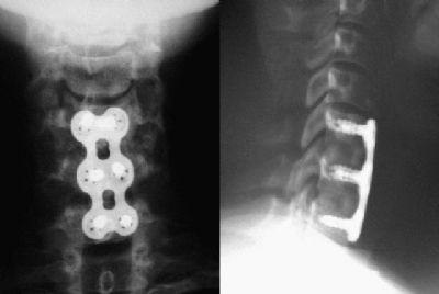 Spine, Cervical:  Synthes CSLP (Implant 41)