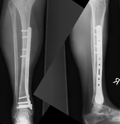Tibial Plate, Unidentified  (Implant 404)