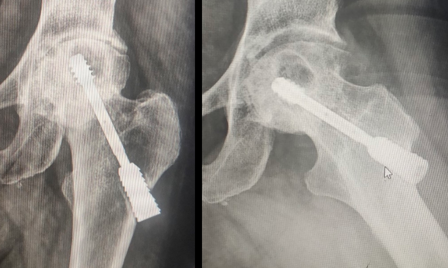 Hip Screw, Unidentified  (Impant 220527)
