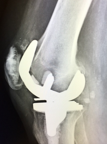 DePuy AMK Total Knee Prosthesis (Implant 160608L)