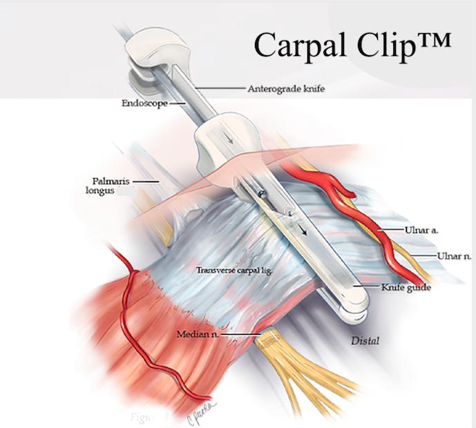 Carpal Clip™ (FP 210802.821)