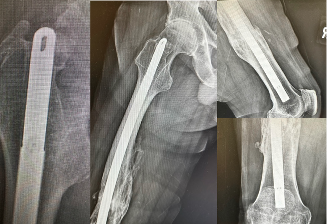 Femoral Nail:  Unidentified (Implant 230203)