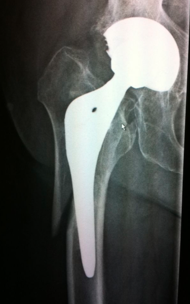 Zimmer APS Natural-Hip (Implant 4271)