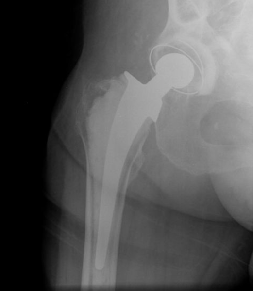 Hip Prosthesis, Total, AP:  Unidentified  (Implant 4284)