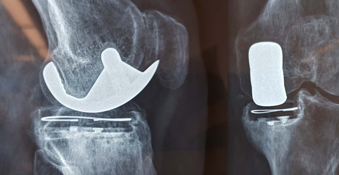 Biomet Repecci Unicompartmental Knee Prosthesis (Implant 1810222)
