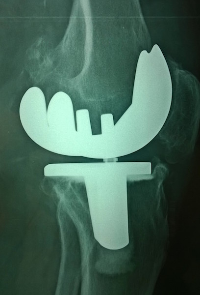 Smith & Nephew TC-PLUS SOLUTION, lat (Implant 160508)