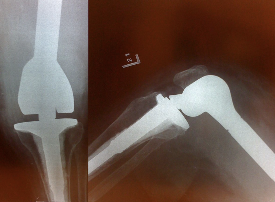 Biomet OSS Total Femur (Implant 4210)