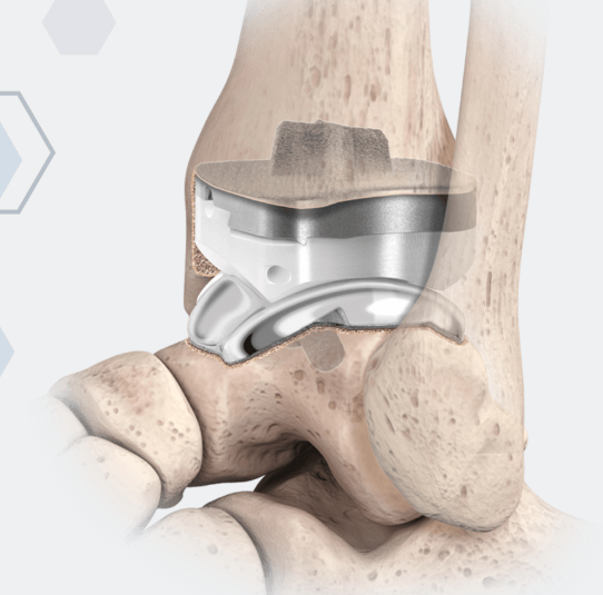 Quantum® Total Ankle System (Prod 250510)