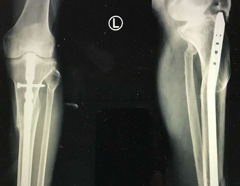 Segmental fracture tibia fixed with supra-patellar nail - YouTube