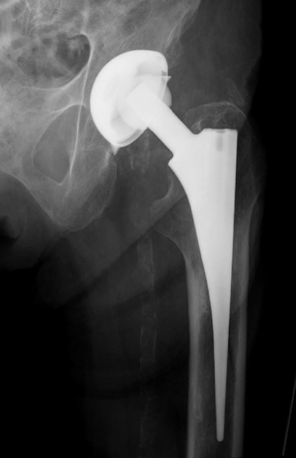Unidentified Total Hip Prosthesis (Implant 230216)